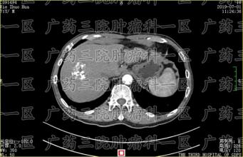 肝癌爱找这6类人，学会6招能帮你躲过一劫