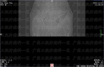 不开胸，食管癌手术也可以这样做