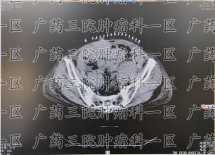 一半舌头长满肿物，多半体内长有肿瘤