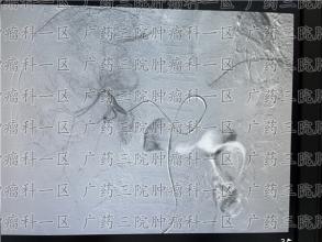 肺癌能活多久？晚期肺癌能活多久？