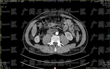 可能导致肝癌的高危因素，你有吗？