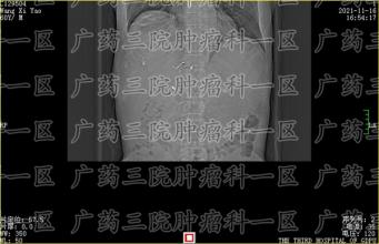 这半年没干了，39岁的衢州男子发展成肝癌