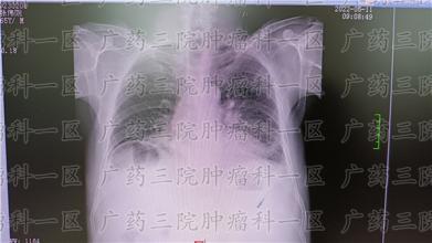 哪些人易发生肺栓塞？大多以呼吸困难为主要
