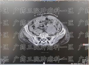 乙肝病患者能活多久