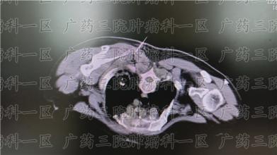 小细胞肺癌患者只能在极少数情况下进行手术