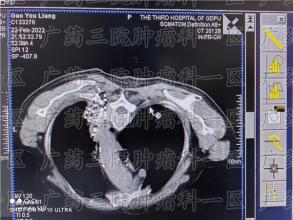 被告知肺小细胞癌不能手术，那还能怎么治