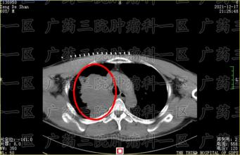 兄妹双双患癌，肿瘤科一区拯救两条生命