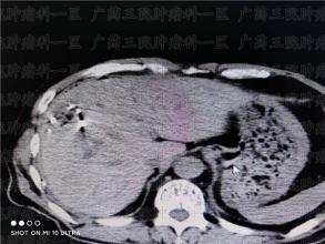 鼻咽癌不想再次放化疗，还能怎么治？