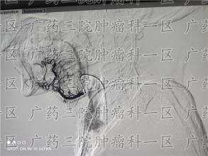 癌症期间，不明原因的暴瘦是严重的开始