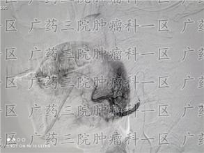 几乎所有癌症患者体重都会有所减轻
