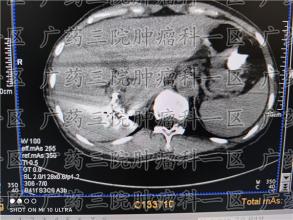 肠癌其实属于“懒癌”