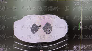 肺癌治疗失败的常见原因
