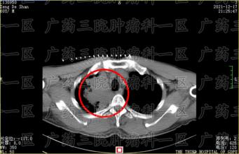 肺癌容易转移到哪里？