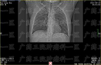 鼻咽癌的治疗方案有哪些