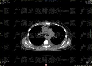 子宫癌的治疗，可不止手术