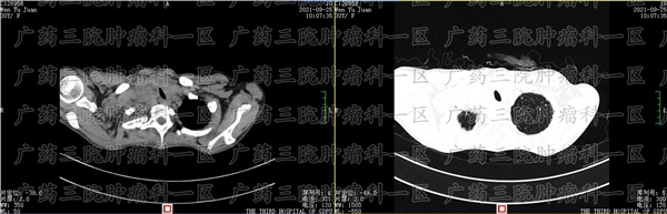 进展期胃癌的治疗比早期胃癌更困难