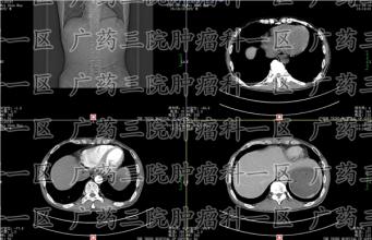 为什么癌细胞会变化这么快？