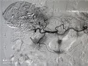 筛查常见的恶性肿瘤都需要做哪些检查？