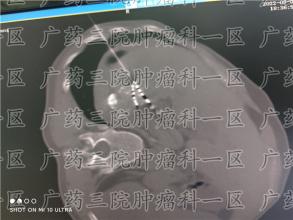 警惕“病从口入”吃出食道癌与胃癌