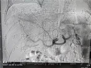 癌症来临前，身体真的会出现征兆吗？
