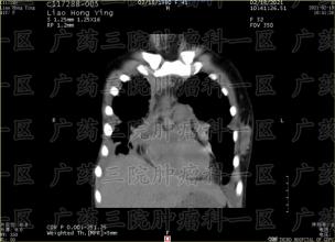 子宫腺肌症，典型症状继发性痛经