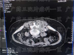 化疗的副作用让很多人望而却步