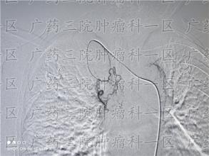 早期结肠肿瘤能怎么治？