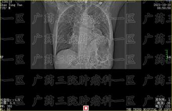 骨转移是肺癌常见的转移部位之一