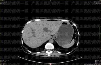 腹部出现肿块，会不会是肿瘤？