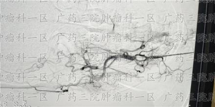 易被误诊的常见癌症都有哪些？