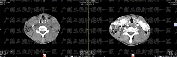 肺癌选择冷冻消融真的有用吗？