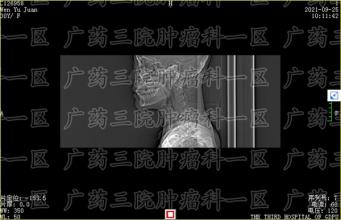 肺炎一直不见好转可是会变肺癌