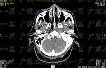 鼻咽癌颈部转移，试试粒子治疗