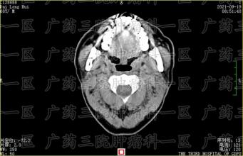 鼻咽癌如果不想手术，可以做微创手术恢复