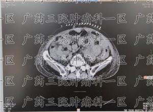 胸腺癌|几乎所有的癌症患者都会出现消瘦