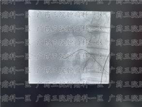 别再放弃，肝癌失去手术机会，同样能治