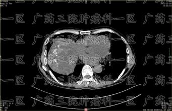 疫情管控逐步放开，肿瘤患者该如何保护自己