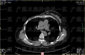 胸腺癌是一种罕见的侵袭性恶性肿瘤
