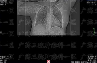 广东东莞黄江哪家医院的鼻咽癌伽玛刀比较好