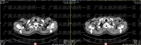 广州台山那家鼻咽肿瘤医院好