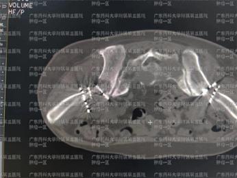 广州廉江微创治癌症骨转移肿瘤医院好