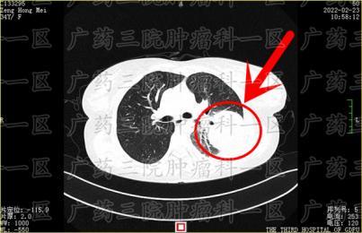 肇庆肿瘤医院治疗肺癌淋巴结转移肿瘤专业吗