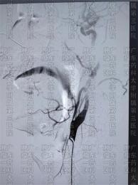 11岁小孩确诊淋巴瘤，广药三院肿瘤科一区