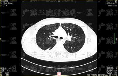 #肺癌晚期而且已经扩散了能治疗吗#广东药