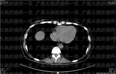 穿刺活检到底能不能做？会不会转移？