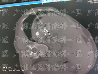 #肝癌晚期还能治疗吗#广东药科大学广州复